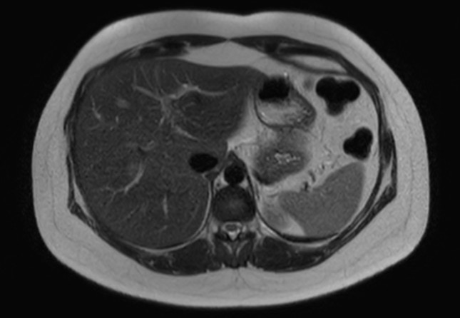 File:Normal liver MRI with Gadolinium (Radiopaedia 58913-66163 Axial T2 23).jpg