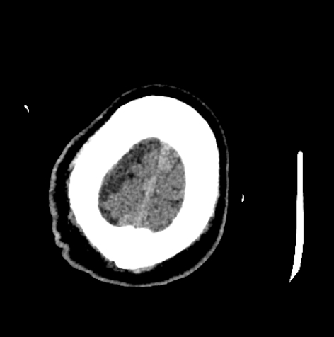 Normal pressure hydrocephalus (Radiopaedia 73685-84479 Axial non-contrast 76).jpg