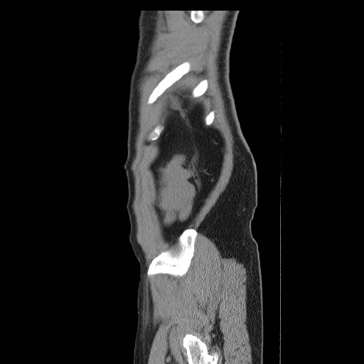 File:Obstructed kidney with perinephric urinoma (Radiopaedia 26889-27066 B 56).jpg
