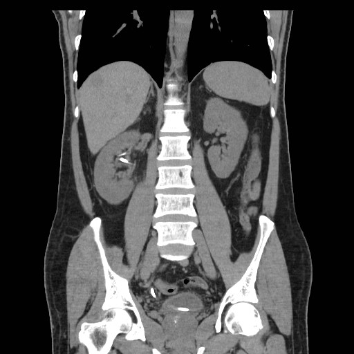 File:Obstructed kidney with perinephric urinoma (Radiopaedia 26889-27067 Coronal non-contrast 1).jpg