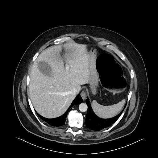 File:Obstructing sigmoid adenocarcinoma (Radiopaedia 58465-65619 Axial 125).jpg