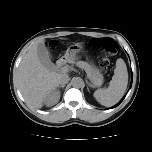 File:Obstructing ureteric calculus (Radiopaedia 18615-18514 Axial non-contrast 16).jpg