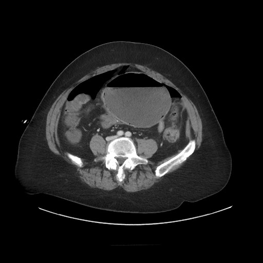 Obstructive distal colonic adenocarcinoma causing cecal perforation (Radiopaedia 86830-102989 A 129).jpg
