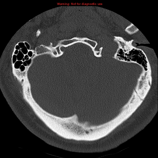 File:Occipital condyle fracture (Radiopaedia 18366-18208 Axial bone window 6).jpg