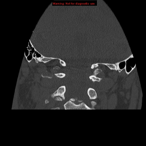 File:Occipital condyle fracture (Radiopaedia 18366-18208 Coronal bone window 16).jpg
