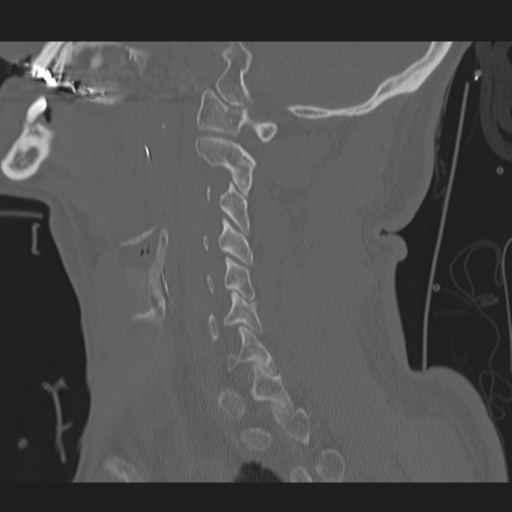 File:Occipital condyle fracture (Radiopaedia 33467-34517 Sagittal bone window 24).png