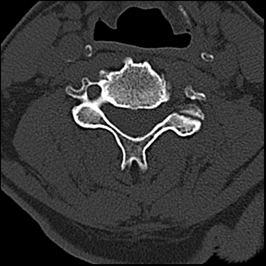 Occipital condyle fracture (type 1) (Radiopaedia 87670-104084 Axial bone window 50).jpg