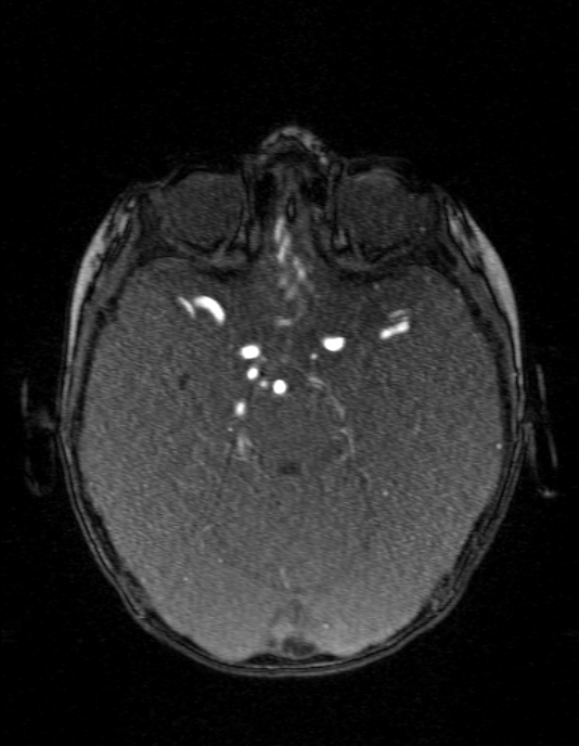 Occipital horn syndrome (Radiopaedia 14255-14129 MRA 57).jpg