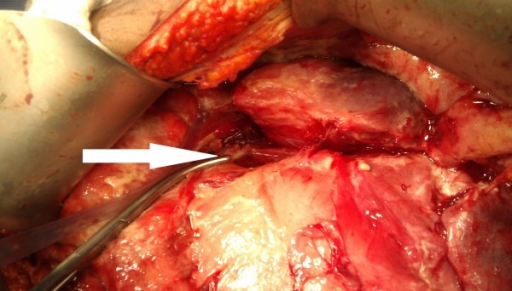 Pancreatic pseudocyst can be seen pushing the stomach and duodenum anteriorly at time of surgery
