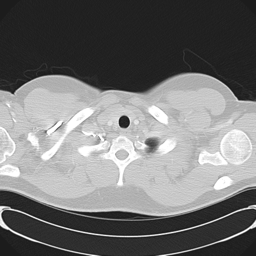 'Bovine' aortic arch (Radiopaedia 33554-34637 Axial lung window 5).png