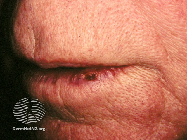 File:(DermNet NZ herpes-simplex-labialis-18).jpg
