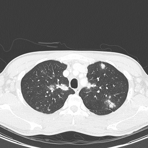 AIDS-related Kaposi sarcoma (Radiopaedia 85247-100811 Axial lung window 37).jpg
