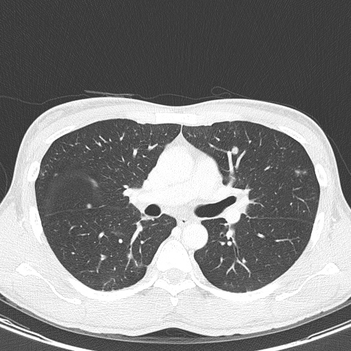 AIDS-related Kaposi sarcoma (Radiopaedia 85247-100811 Axial lung window 72).jpg