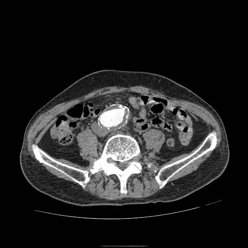 Abdominal aortic aneurysm (Radiopaedia 13341-13340 Axial C+ arterial phase 151).jpg