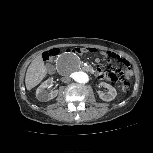 Abdominal aortic aneurysm (Radiopaedia 13341-13340 Axial C+ arterial phase 88).jpg