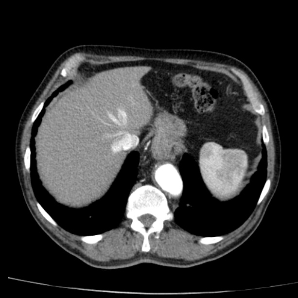Abdominal aortic aneurysm (Radiopaedia 29248-29660 Axial C+ arterial phase 12).jpg