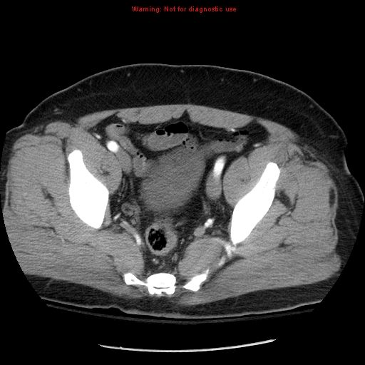 Abdominal aortic aneurysm (Radiopaedia 8190-9038 Axial C+ arterial phase 72).jpg