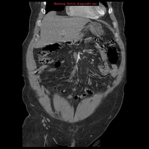 Abdominal aortic aneurysm (Radiopaedia 8190-9038 Coronal C+ arterial phase 31).jpg