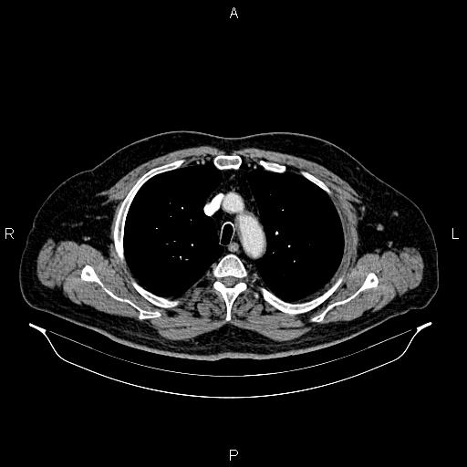 File:Abdominal aortic aneurysm (Radiopaedia 83094-97462 Axial renal cortical phase 21).jpg