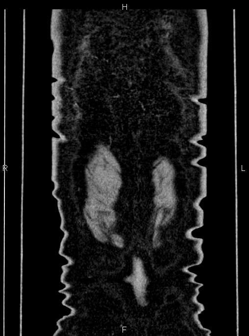 Abdominal aortic aneurysm (Radiopaedia 83094-97462 Coronal renal cortical phase 92).jpg