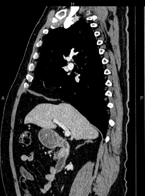 Abdominal aortic aneurysm (Radiopaedia 83094-97462 Sagittal renal cortical phase 50).jpg