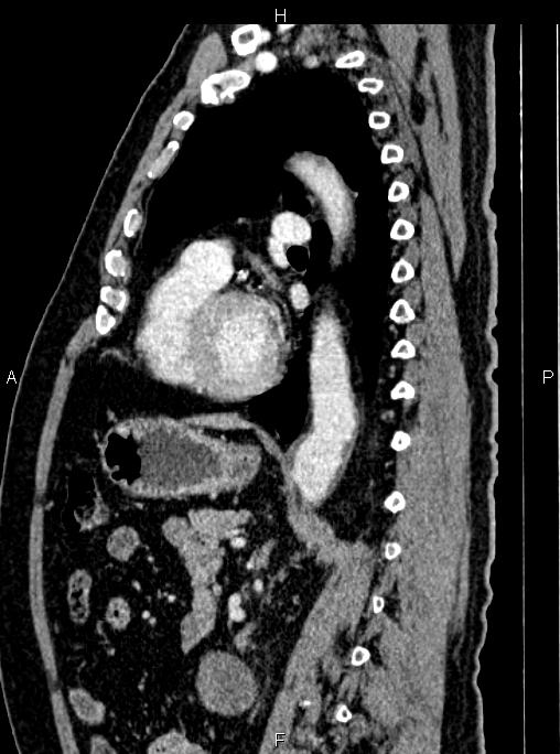 Abdominal aortic aneurysm (Radiopaedia 83094-97462 Sagittal renal cortical phase 76).jpg