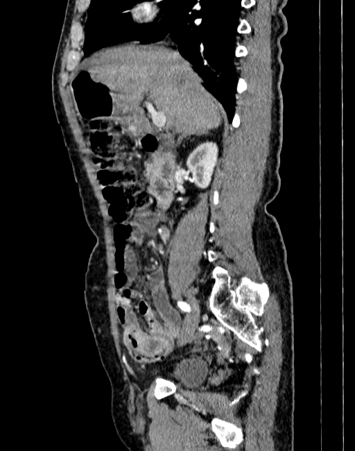 Abdominal aortic aneurysm (Radiopaedia 83581-98689 Sagittal C+ arterial phase 15).jpg