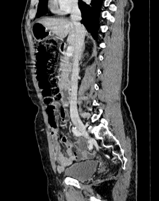 Abdominal aortic aneurysm (Radiopaedia 83581-98689 Sagittal C+ portal venous phase 28).jpg