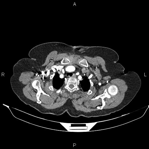 File:Abdominal aortic aneurysm (Radiopaedia 85063-100606 Axial C+ arterial phase 7).jpg