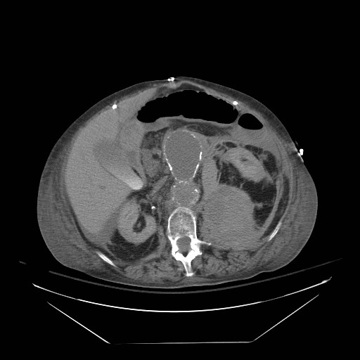 Abdominal aortic aneurysm - impending rupture (Radiopaedia 19233-19247 Axial non-contrast 72).jpg