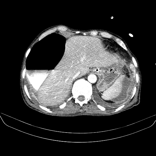 File:Abdominal collection due to previous cecal perforation (Radiopaedia 80831-94320 Axial C+ portal venous phase 31).jpg