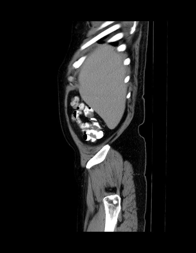 Abdominal lymphoma - with sandwich sign (Radiopaedia 53486-59492 Sagittal C+ portal venous phase 71).jpg