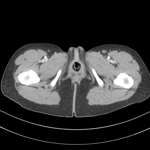 File:Abdominal multi-trauma - devascularised kidney and liver, spleen and pancreatic lacerations (Radiopaedia 34984-36486 Axial C+ portal venous phase 91).png