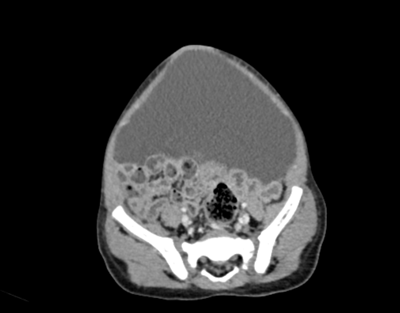 Abdominal premesenteric cystic lymphangioma (Radiopaedia 82995-97350 Axial C+ portal venous phase 51).jpg