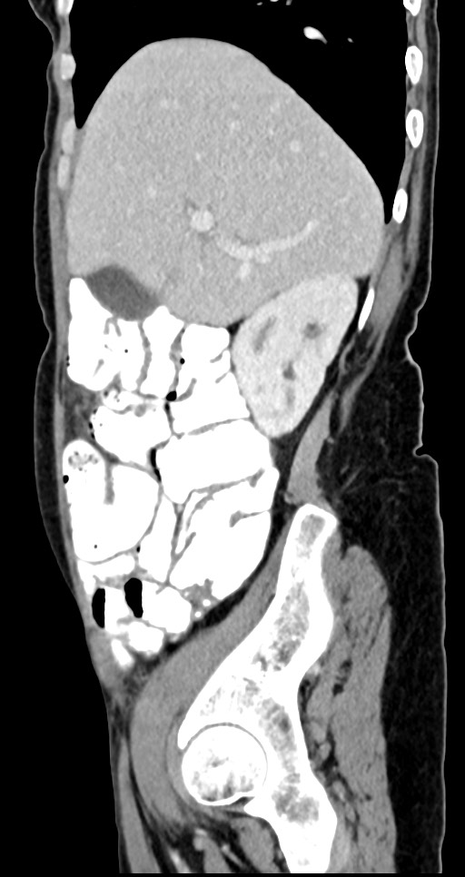 Abdominal wall and retroperitoneal tuberculosis (Radiopaedia 88137-104729 Sagittal C+ portal venous phase 111).jpg