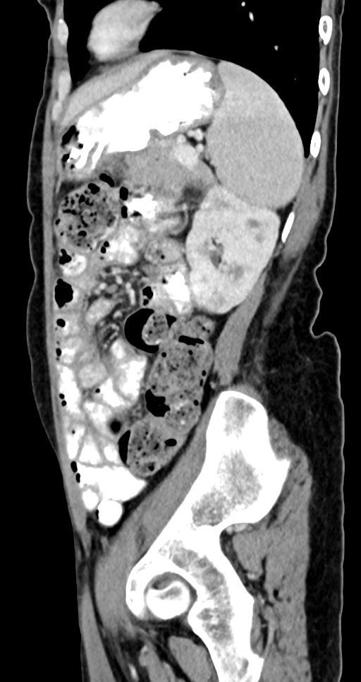 Abdominal wall and retroperitoneal tuberculosis (Radiopaedia 88137-104729 Sagittal C+ portal venous phase 45).jpg