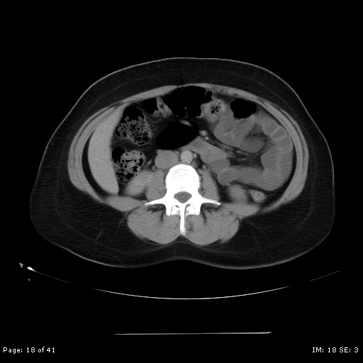 File:Abdominal wall endometriosis (Radiopaedia 25723-25885 Axial C+ portal venous phase 18).jpg