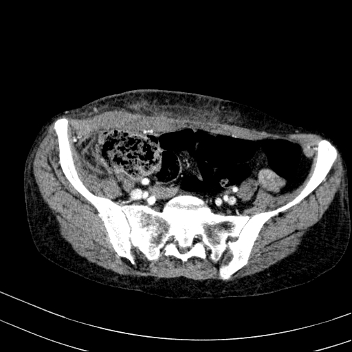 Abdominal wall hematoma with active bleeding (Radiopaedia 83915-99117 Axial renal cortical phase 100).jpg