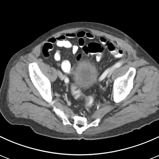 Abdominal wall metastasis from colorectal carcinoma (Radiopaedia 31016-31717 Axial C+ portal venous phase 64).jpg