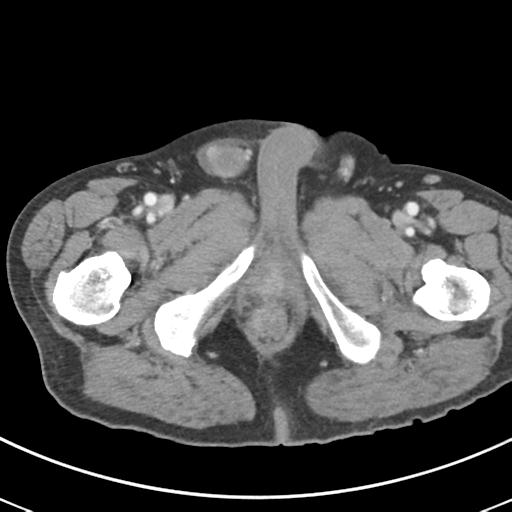 Abdominal wall metastasis from colorectal carcinoma (Radiopaedia 31016-31717 Axial C+ portal venous phase 82).jpg