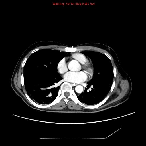 File:Aberrant right subclavian artery (Radiopaedia 9379-10071 Axial C+ arterial phase 38).jpg
