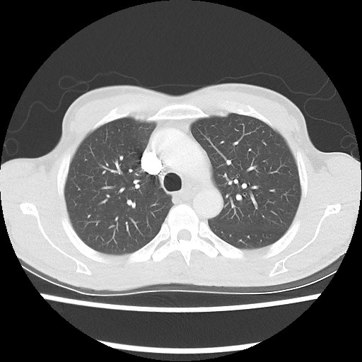 Accessory left horizontal fissure with lingular pneumonia (Radiopaedia 53763-59843 Axial lung window 19).jpg