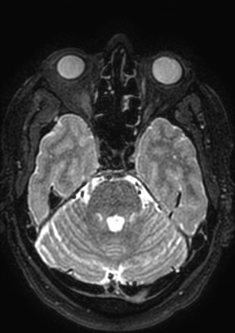 Accessory middle cerebral artery (Radiopaedia 73114-83828 Axial T2 147).jpg