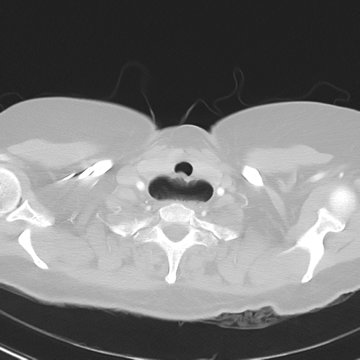 File:Achalasia (Radiopaedia 47147-51685 Axial lung window 3).png