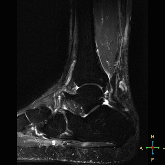 File:Achilles tendon complete tear (Radiopaedia 22834-22854 Sagittal STIR 6).jpg
