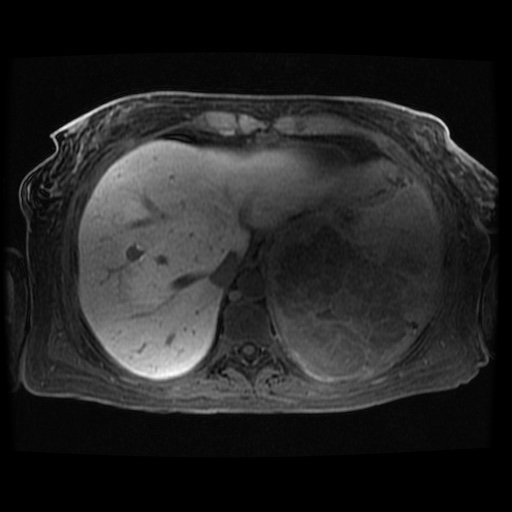 Acinar cell carcinoma of the pancreas (Radiopaedia 75442-86668 Axial late phase (~30 mins) 117).jpg