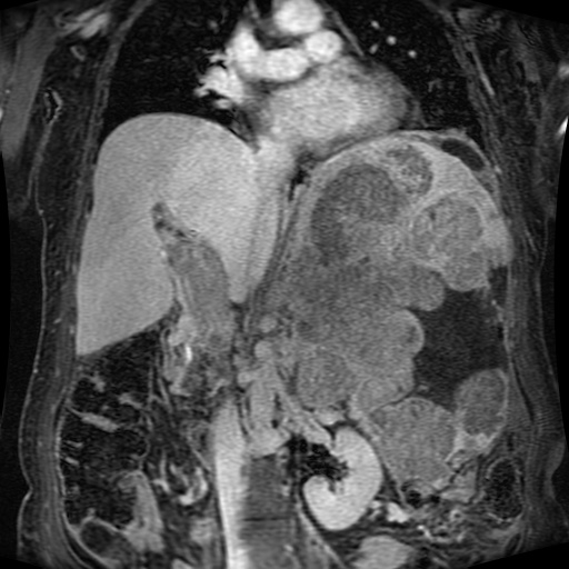 Acinar cell carcinoma of the pancreas (Radiopaedia 75442-86668 Coronal T1 C+ fat sat 99).jpg