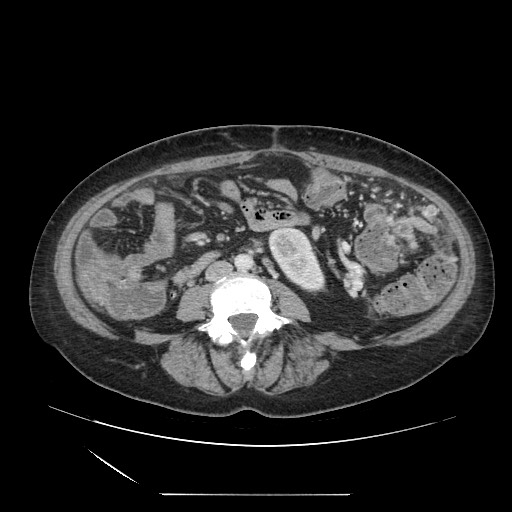 File:Acinar cell carcinoma of the pancreas (Radiopaedia 75442-86669 Axial C+ portal venous phase 85).jpg