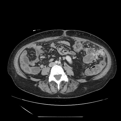Acinar cell carcinoma of the pancreas (Radiopaedia 75442-86669 Axial C+ portal venous phase 88).jpg