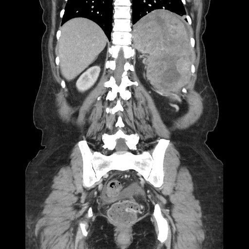 Acinar cell carcinoma of the pancreas (Radiopaedia 75442-86669 Coronal C+ portal venous phase 95).jpg